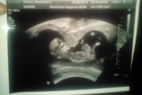 Dealing with a Tough Diagnosis since before Birth