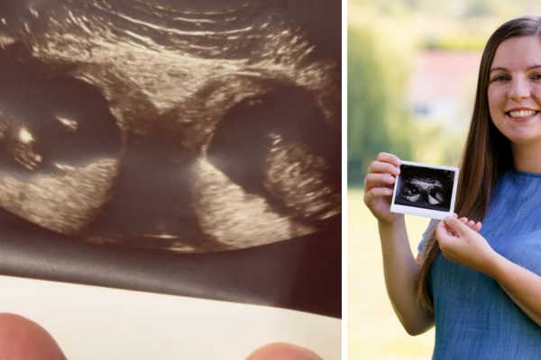 UK mom with two wombs is carrying a twin in each